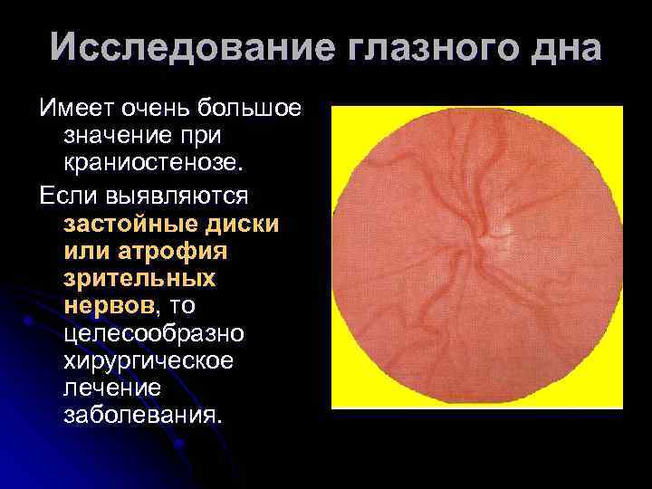 Исследование глазного дна Имеет очень большое значение при краниостенозе. Если выявляются застойные диски или