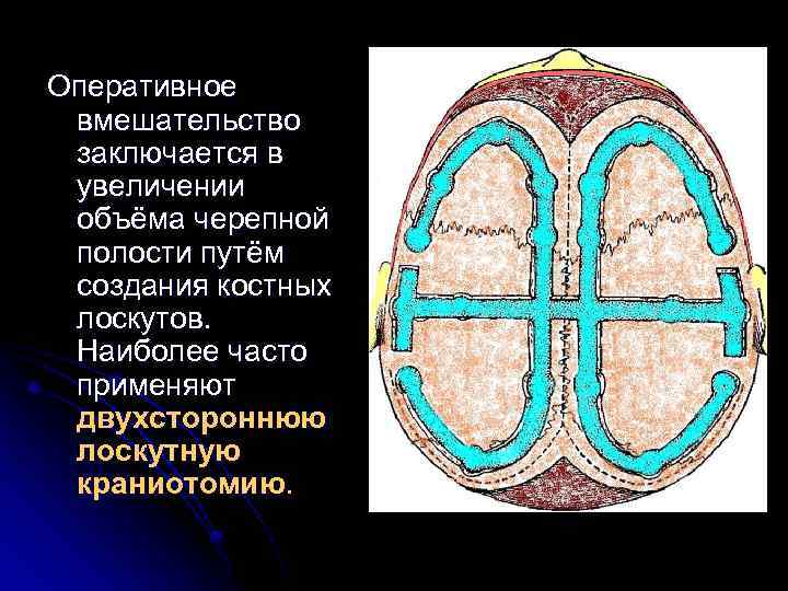 Оперативное вмешательство заключается в увеличении объёма черепной полости путём создания костных лоскутов. Наиболее часто
