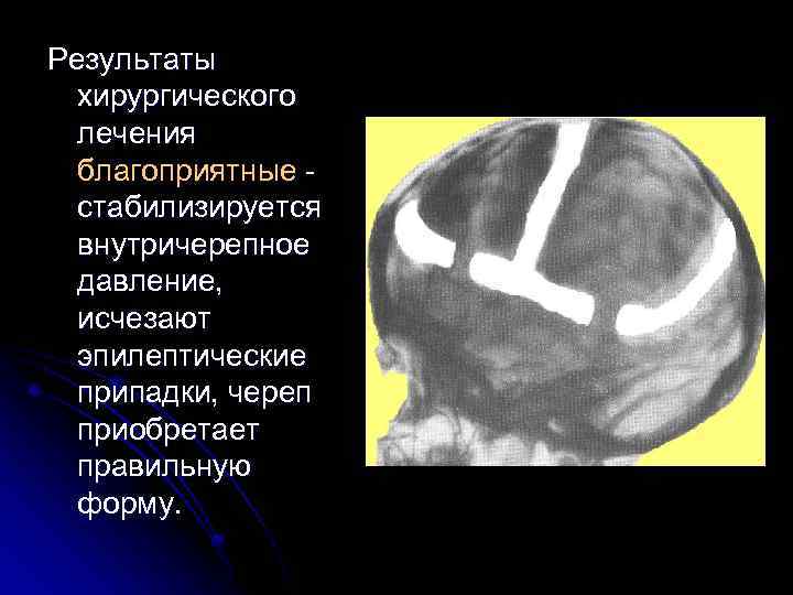 Результаты хирургического лечения благоприятные стабилизируется внутричерепное давление, исчезают эпилептические припадки, череп приобретает правильную форму.