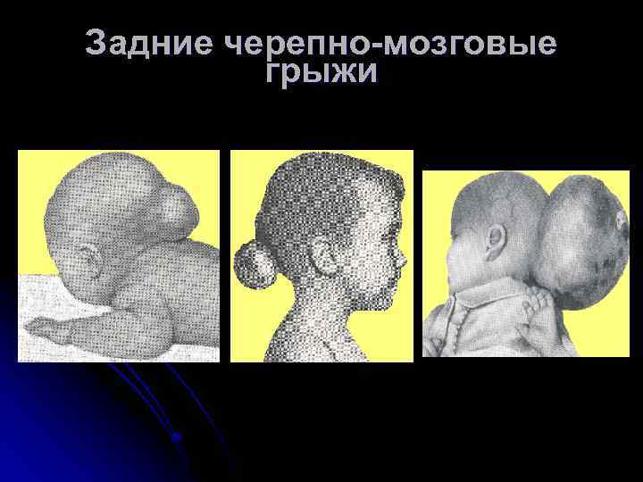 Задние черепно-мозговые грыжи 