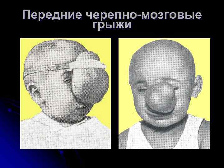 Передние черепно-мозговые грыжи 