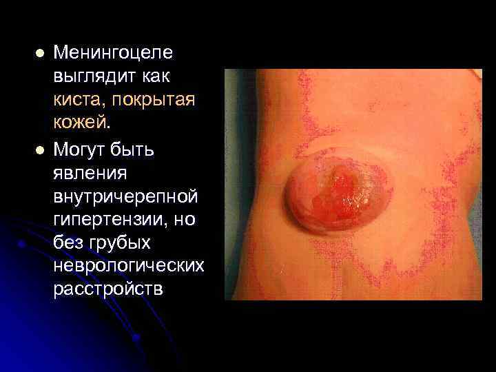 l l Менингоцеле выглядит как киста, покрытая кожей. Могут быть явления внутричерепной гипертензии, но