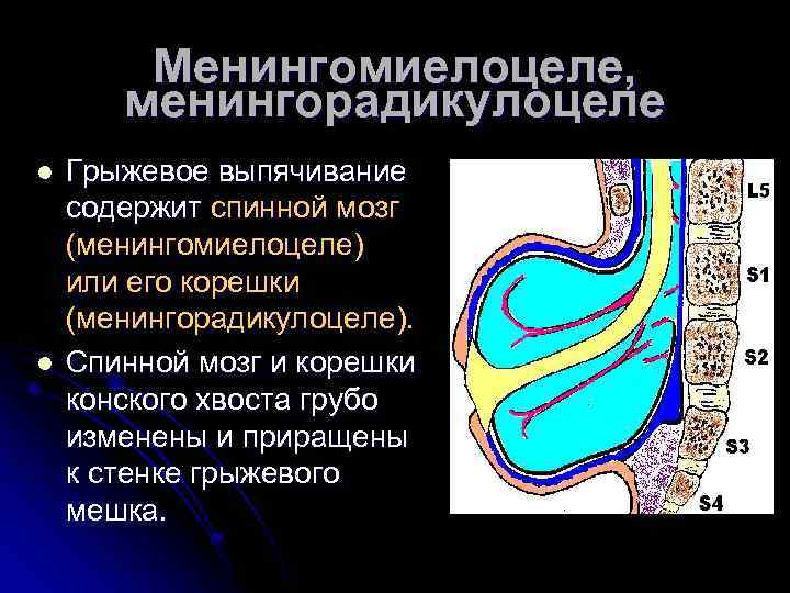 Менингомиелоцеле, менингорадикулоцеле l l Грыжевое выпячивание содержит спинной мозг (менингомиелоцеле) или его корешки (менингорадикулоцеле).