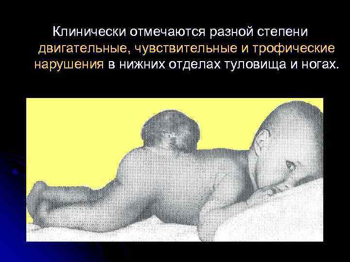 Клинически отмечаются разной степени двигательные, чувствительные и трофические нарушения в нижних отделах туловища и