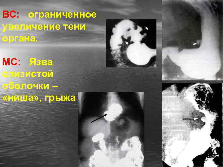 ВС: ограниченное увеличение тени органа. МС: Язва слизистой оболочки – «ниша» , грыжа 