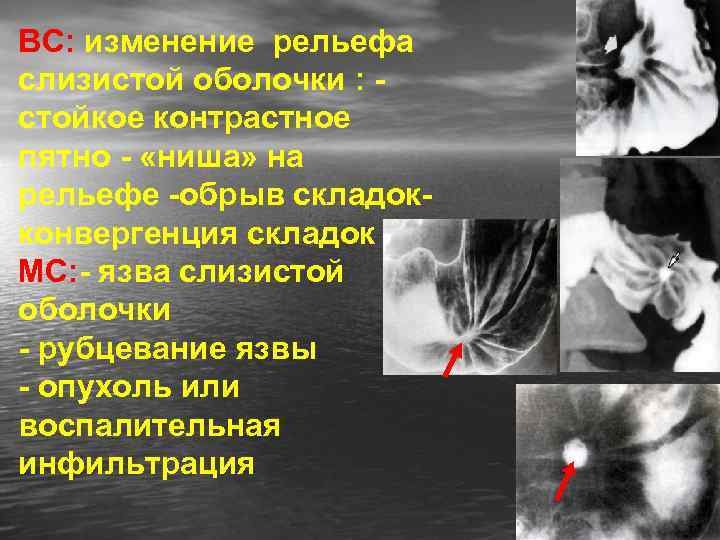 ВС: изменение рельефа слизистой оболочки : стойкое контрастное пятно - «ниша» на рельефе -обрыв