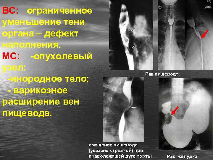 ВС: ограниченное уменьшение тени органа – дефект наполнения. МС: -опухолевый узел: -инородное тело; -