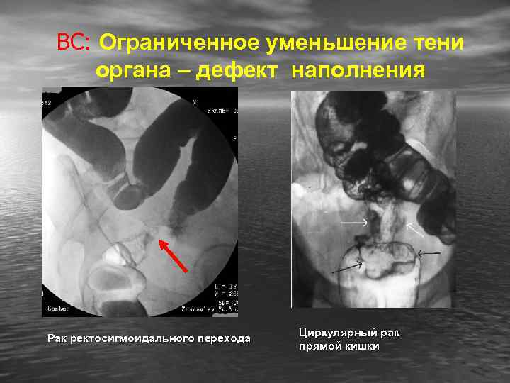 ВС: Ограниченное уменьшение тени органа – дефект наполнения Рак ректосигмоидального перехода Циркулярный рак прямой