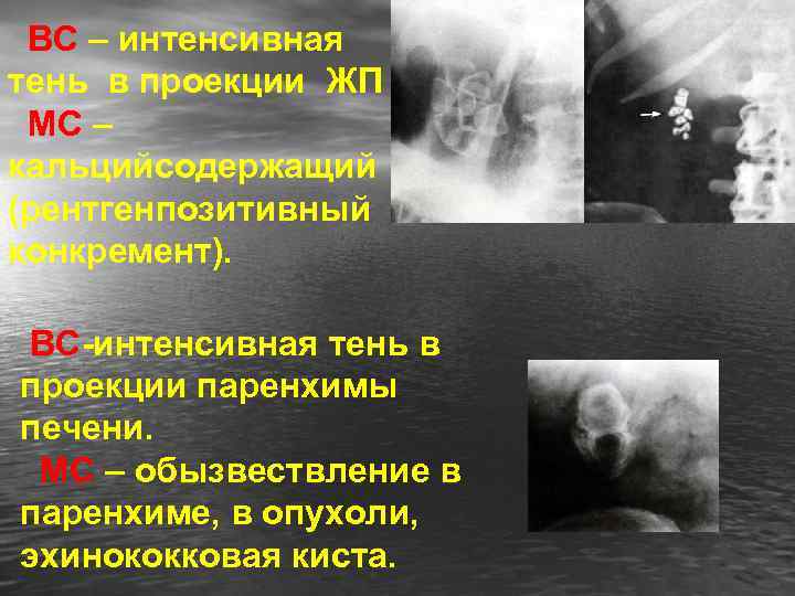 ВС – интенсивная тень в проекции ЖП МС – кальцийсодержащий (рентгенпозитивный конкремент). ВС-интенсивная тень