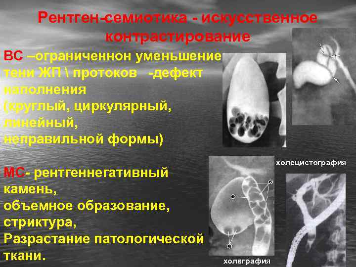 Рентген-семиотика - искусственное контрастирование ВС –ограниченнон уменьшение тени ЖП  протоков -дефект наполнения (круглый,