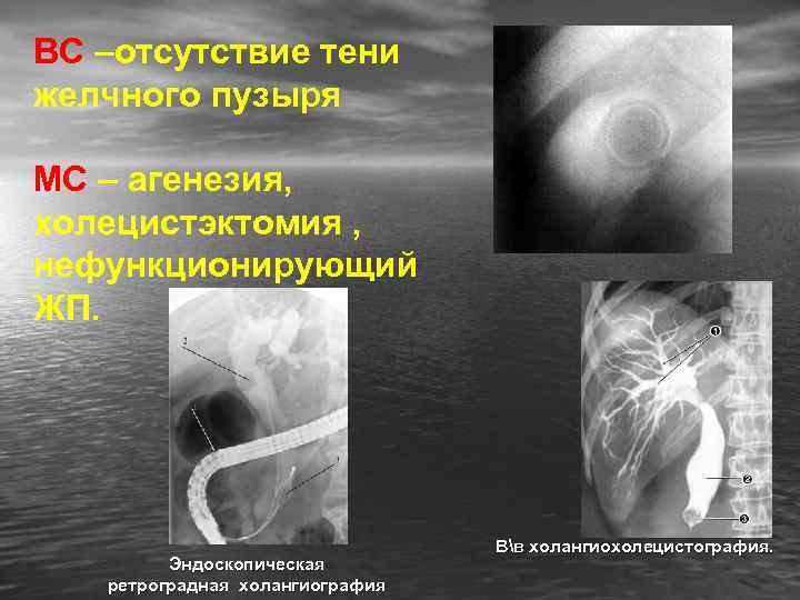 ВС –отсутствие тени желчного пузыря МС – агенезия, холецистэктомия , нефункционирующий ЖП. Эндоскопическая ретроградная