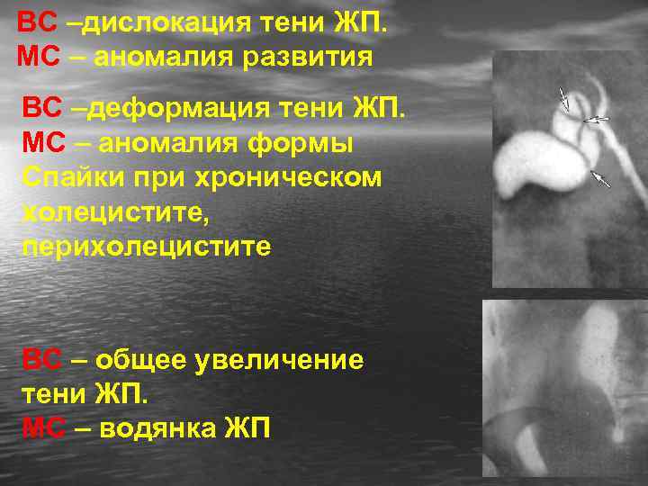ВС –дислокация тени ЖП. МС – аномалия развития ВС –деформация тени ЖП. МС –
