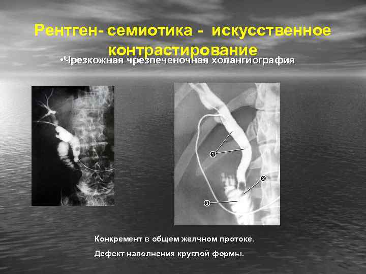 Рентген- семиотика - искусственное контрастирование • Чрезкожная чрезпеченочная холангиография Конкремент в общем желчном протоке.