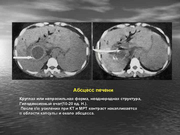 Абсцесс печени Круглая или неправильная форма, неоднородная структура, Гиподенсивный очаг(10 -20 ед. Н. ).