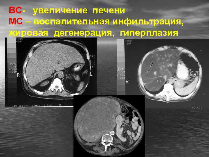 ВС- увеличение печени МС – воспалительная инфильтрация, жировая дегенерация, гиперплазия 
