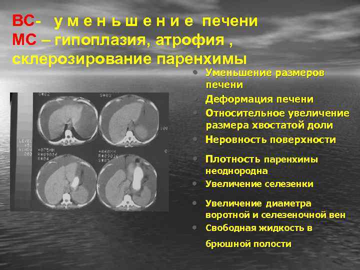 ВС- у м е н ь ш е н и е печени МС –