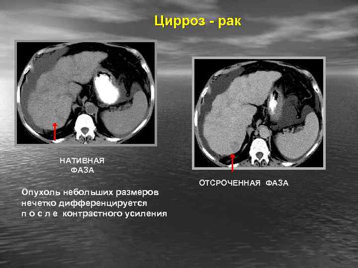Цирроз - рак НАТИВНАЯ ФАЗА Опухоль небольших размеров нечетко дифференцируется п о с л