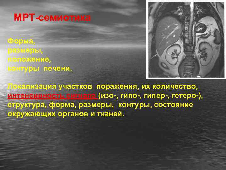 МРТ-семиотика Форма, размеры, положение, контуры печени. Локализация участков поражения, их количество, интенсивность сигнала (изо-,