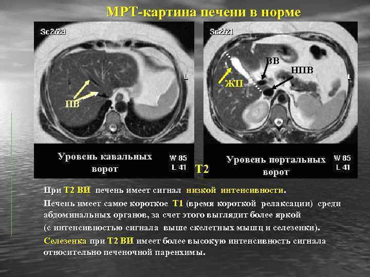 МРТ-картина печени в норме ВВ НПВ ЖП ПВ Уровень кавальных ворот Т 2 Уровень