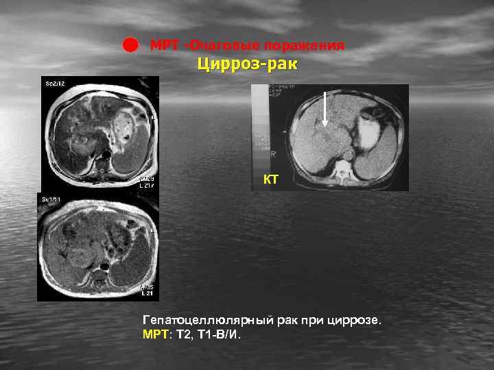 МРТ -Очаговые поражения Цирроз-рак КТ Гепатоцеллюлярный рак при циррозе. МРТ: Т 2, Т 1
