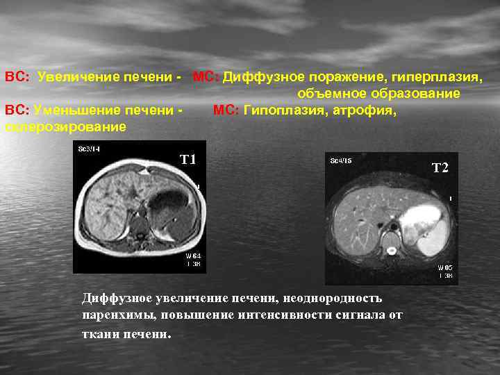 ВС: Увеличение печени - МС: Диффузное поражение, гиперплазия, объемное образование ВС: Уменьшение печени МС: