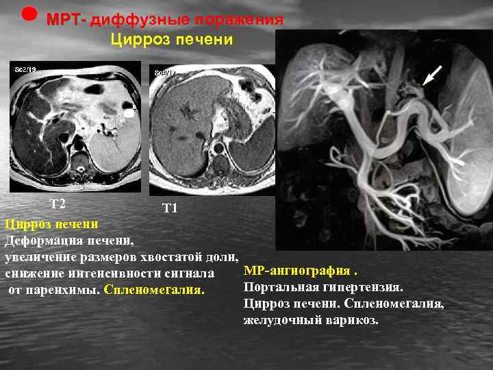 МРТ- диффузные поражения Цирроз печени Т 2 Т 1 Цирроз печени Деформация печени, увеличение
