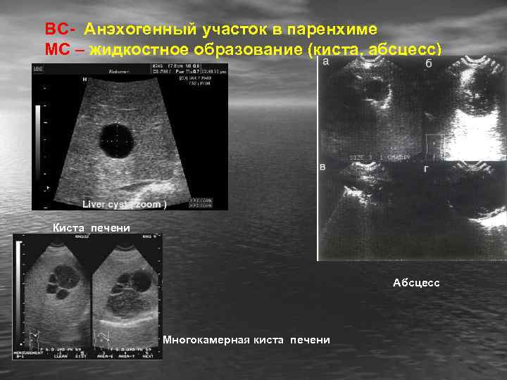 ВС- Анэхогенный участок в паренхиме МС – жидкостное образование (киста, абсцесс) Киста печени Абсцесс