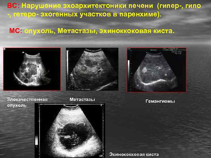 ВС: Нарушение эхоархитектоники печени (гипер-, гипо -, гетеро- эхогенных участков в паренхиме). МС: опухоль,