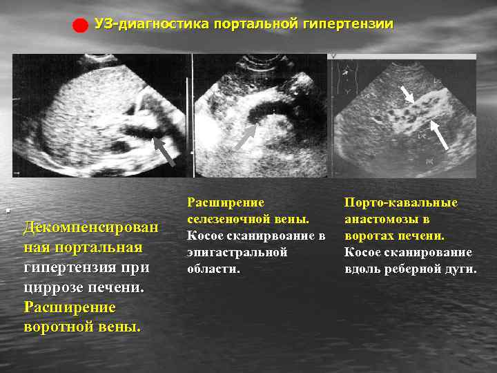 УЗ-диагностика портальной гипертензии . Декомпенсирован ная портальная гипертензия при циррозе печени. Расширение воротной вены.