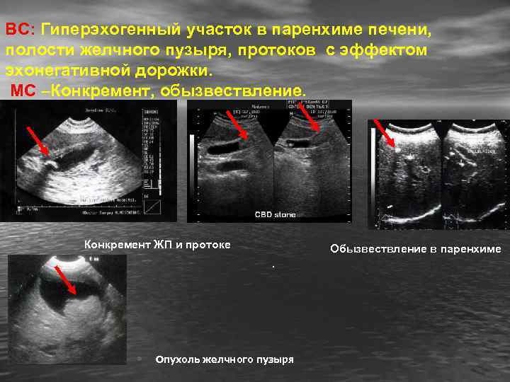 ВС: Гиперэхогенный участок в паренхиме печени, полости желчного пузыря, протоков с эффектом эхонегативной дорожки.