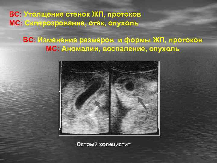 ВС: Утолщение стенок ЖП, протоков МС: Склерозрование, отек, опухоль ВС: Изменение размеров и формы