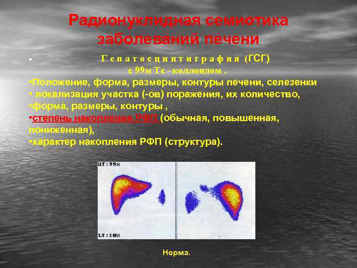 Радионуклидная семиотика заболеваний печени Г е п а т о с ц и н