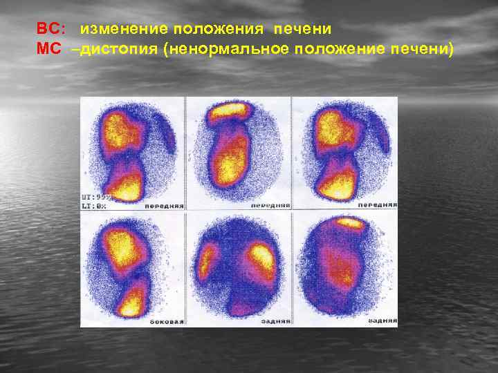 ВС: изменение положения печени МС –дистопия (ненормальное положение печени) 