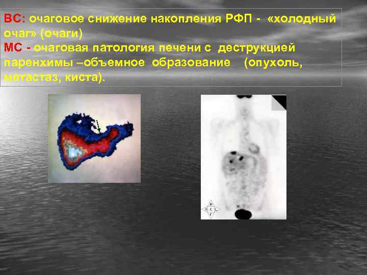 ВС: очаговое снижение накопления РФП - «холодный очаг» (очаги) МС - очаговая патология печени