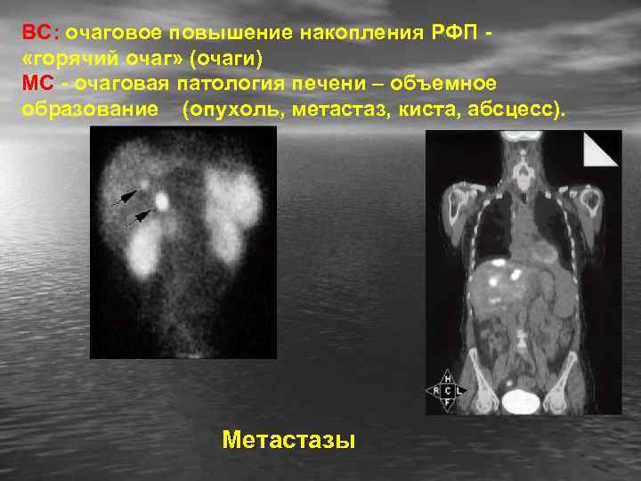 ВС: очаговое повышение накопления РФП «горячий очаг» (очаги) МС - очаговая патология печени –