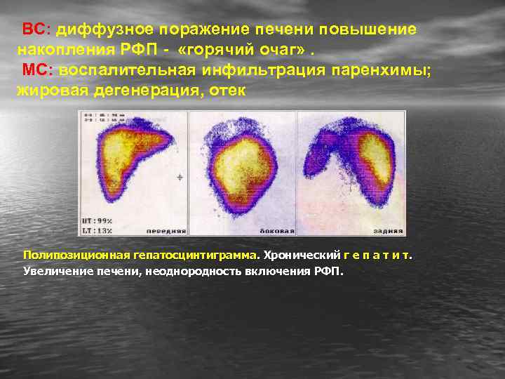 ВС: диффузное поражение печени повышение накопления РФП - «горячий очаг» . МС: воспалительная инфильтрация