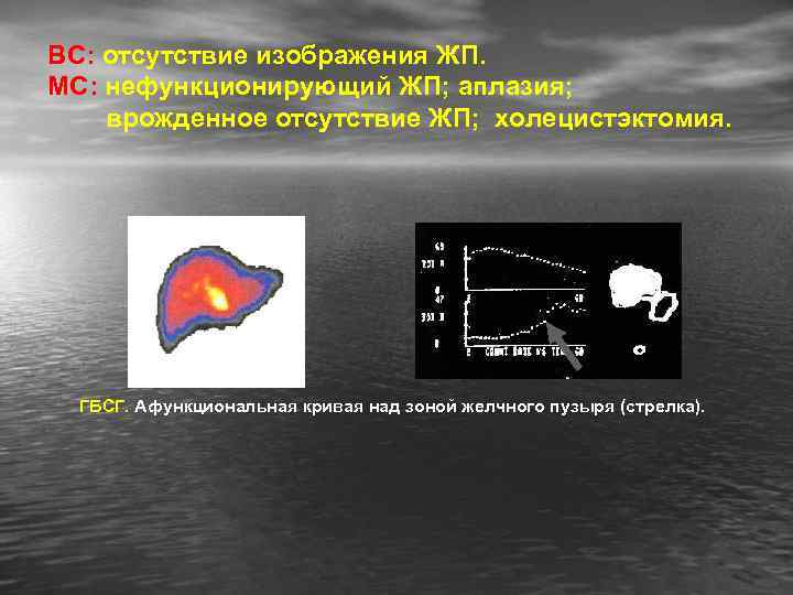 ВС: отсутствие изображения ЖП. МС: нефункционирующий ЖП; аплазия; врожденное отсутствие ЖП; холецистэктомия. ГБСГ. Афункциональная