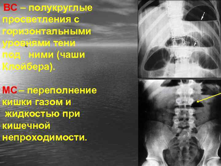 ВС – полукруглые просветления с горизонтальными уровнями тени • под ними (чаши Клойбера). МС