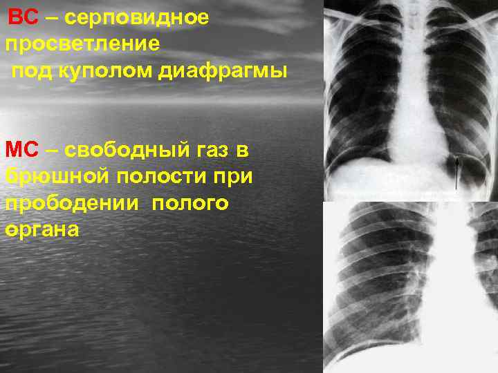 ВС – серповидное просветление под куполом диафрагмы МС – свободный газ в брюшной полости