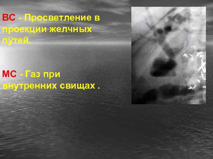 ВС - Просветление в проекции желчных путей. МС - Газ при внутренних свищах. 