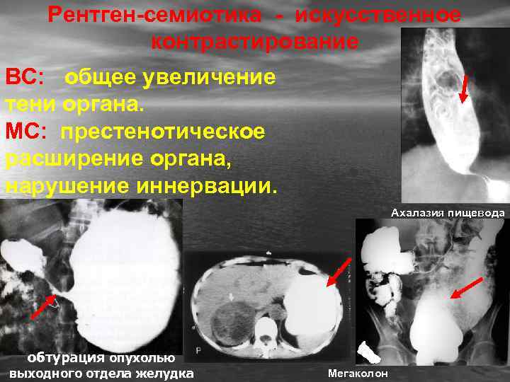 Рентген-семиотика - искусственное контрастирование ВС: общее увеличение тени органа. МС: престенотическое расширение органа, нарушение