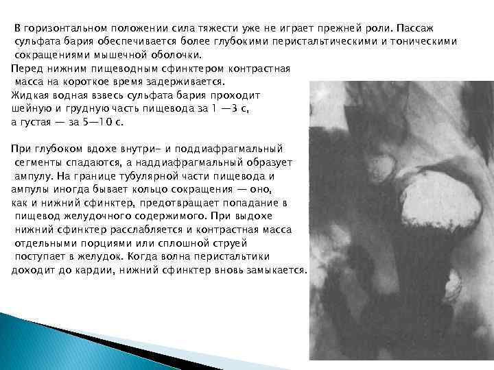 В горизонтальном положении сила тяжести уже не играет прежней роли. Пассаж сульфата бария обеспечивается