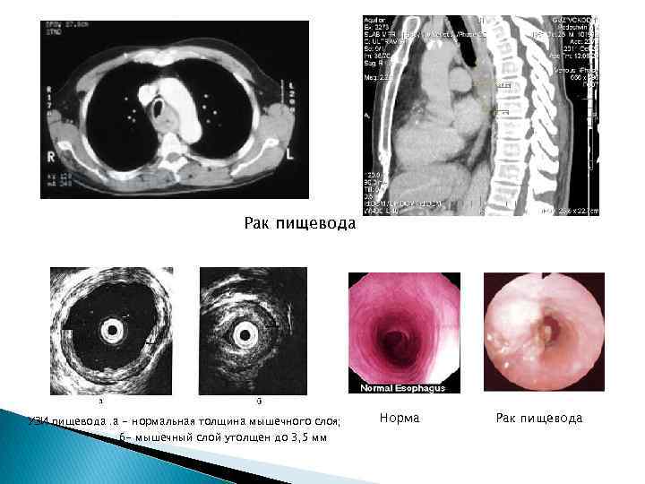 Рак пищевода УЗИ пищевода. а - нормальная толщина мышечного слоя; б- мышечный слой утолщен