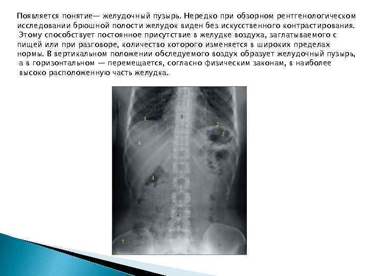 Появляется понятие— желудочный пузырь. Нередко при обзорном рентгенологическом исследовании брюшной полости желудок виден без
