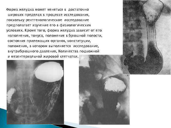 Форма желудка может меняться в достаточно широких пределах в процессе исследования, поскольку рентгенологическое исследование