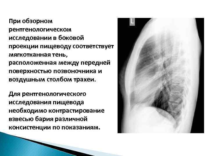 При обзорном рентгенологическом исследовании в боковой проекции пищеводу соответствует мягкотканная тень, расположенная между передней