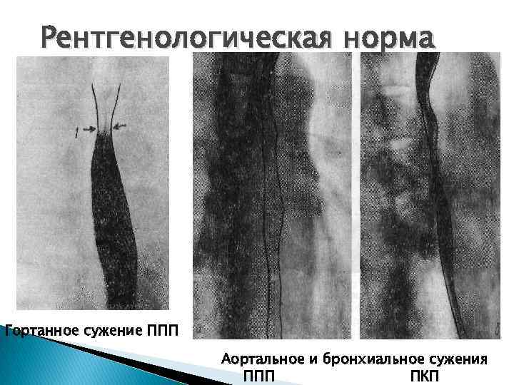 Рентгенологическая норма Гортанное сужение ППП Аортальное и бронхиальное сужения ППП ПКП 