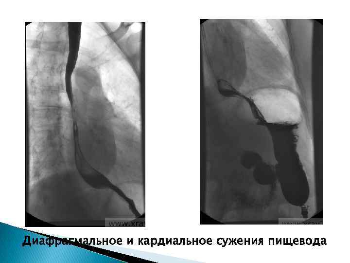 Диафрагмальное и кардиальное сужения пищевода 