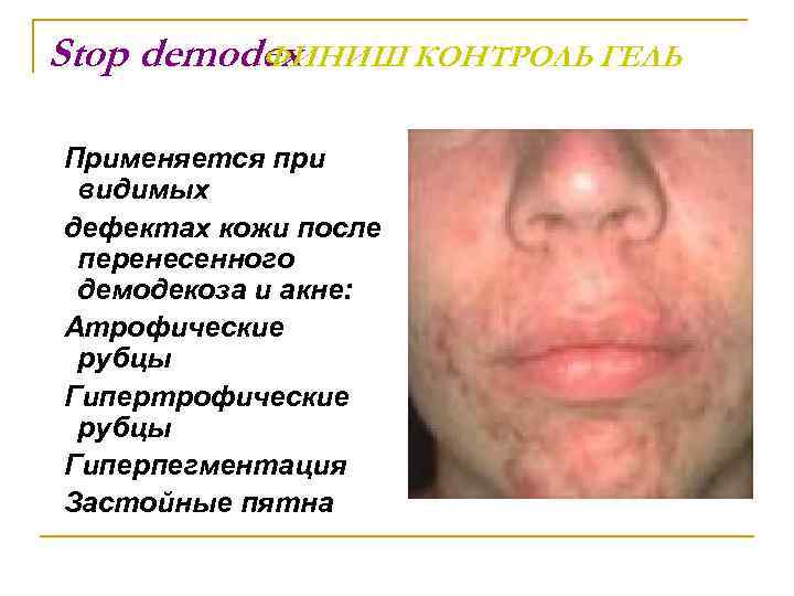 Stop demodex ФИНИШ КОНТРОЛЬ ГЕЛЬ Применяется при видимых дефектах кожи после перенесенного демодекоза и
