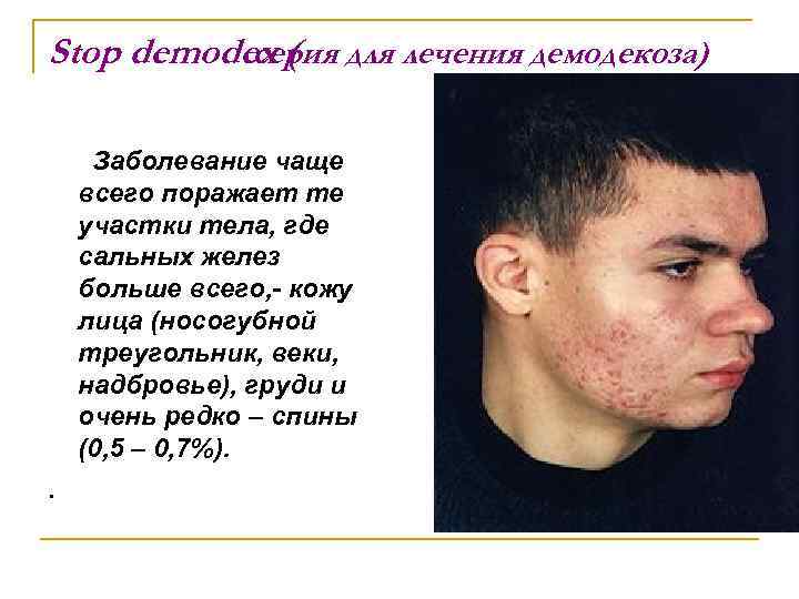 Stop demodex ( для лечения демодекоза) серия Заболевание чаще всего поражает те участки тела,